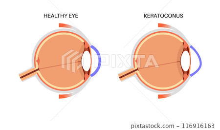 Cataract eye disease Cataract eye disease 116916163