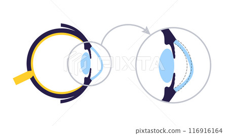 Cataract eye disease 116916164