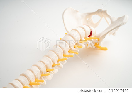 Lumbar spine displaced herniated disc fragment, spinal nerve and bone. Model for treatment medical in the orthopedic department. 116917495
