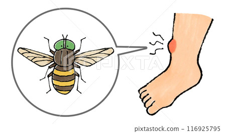 Horsefly bitten leg 116925795