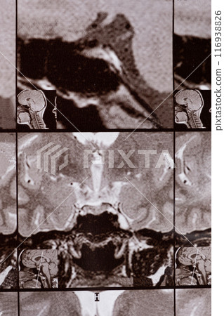 Magnetic resonance imaging of the head of a healthy person, image of the pituitary gland. Magnetic resonance imaging of the head of a healthy person, image of the pituitary gland. 116938826