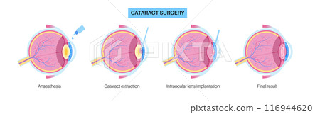 Cataract surgery poster 116944620