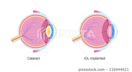 Intraocular lenses poster 116944621