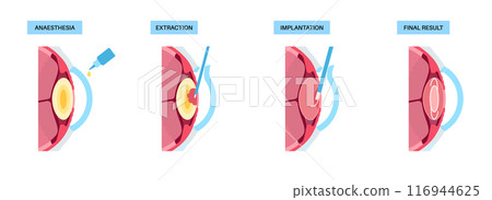 Cataract surgery poster Cataract surgery poster 116944625