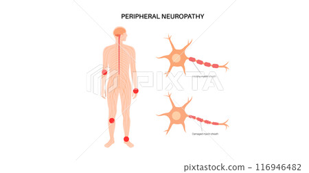 Peripheral neuropathy medical poster 116946482