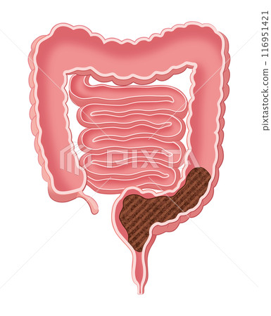 Intestines filled with stool Intestines filled with stool 116951421