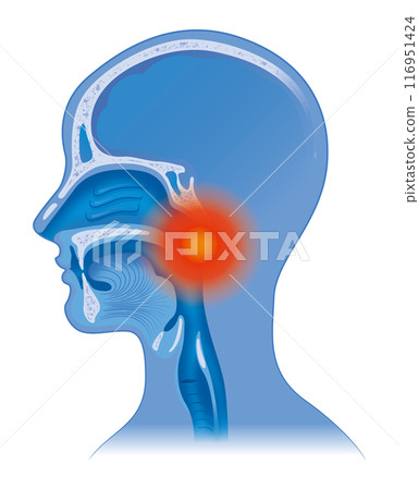 Sore throat 116951424