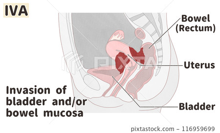 Uterine cancer stage IVA (stage 4A) - Easy-to-understand English illustrations 116959699