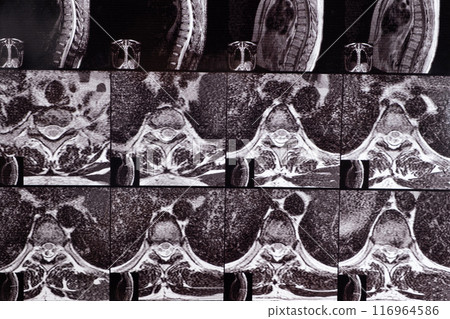 MRI of a patient with intervertebral disc protrusion and osteochondrosis of the thoracic spine MRI of a patient with intervertebral disc protrusion and osteochondrosis of the thoracic spine 116964586