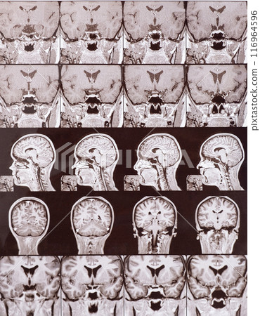 Magnetic resonance imaging of the head of a healthy person, image of the pituitary gland. Magnetic resonance imaging of the head of a healthy person, image of the pituitary gland. 116964596