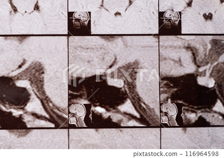 Magnetic resonance imaging of the head of a healthy person, image of the pituitary gland. Magnetic resonance imaging of the head of a healthy person, image of the pituitary gland. 116964598