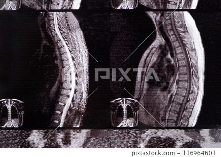 MRI of a patient with intervertebral disc protrusion and osteochondrosis of the thoracic spine 116964601