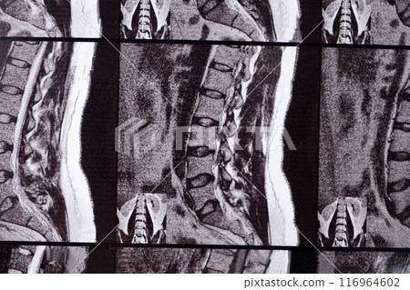 MRI of a patient with intervertebral disc protrusion and osteochondrosis of the thoracic spine 116964602