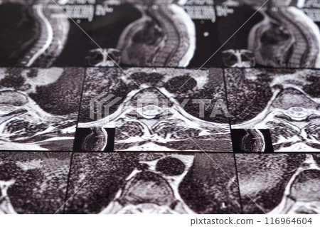 MRI of a patient with intervertebral disc protrusion and osteochondrosis of the thoracic spine MRI of a patient with intervertebral disc protrusion and osteochondrosis of the thoracic spine 116964604