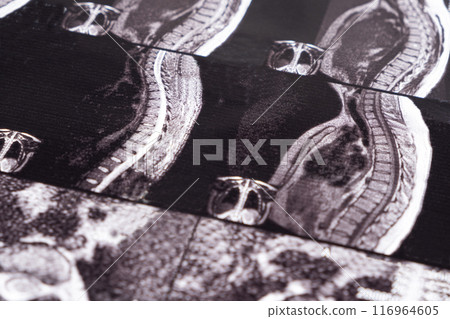 MRI of a patient with intervertebral disc protrusion and osteochondrosis of the thoracic spine MRI of a patient with intervertebral disc protrusion and osteochondrosis of the thoracic spine 116964605