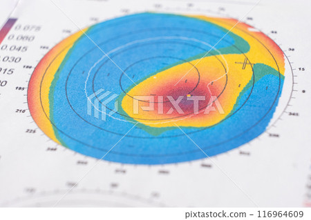 Results of the examination of the thickness and curvature of the cornea in a patient with keratoconus 116964609