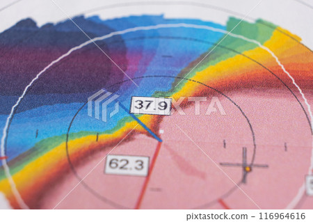 Results of the examination of the thickness and curvature of the cornea in a patient with keratoconus 116964616