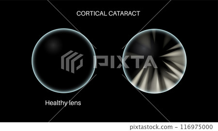 Cataract eye disease 116975000
