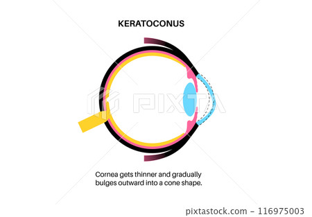 Cataract eye disease 116975003