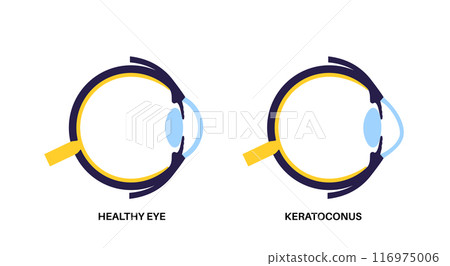 Cataract eye disease 116975006