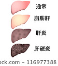 肝硬化 116977388