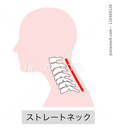 Illustration of the cervical vertebrae in a straight neck 116989126