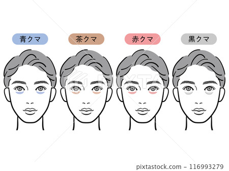 Types of dark circles under the eyes (for men) 116993279