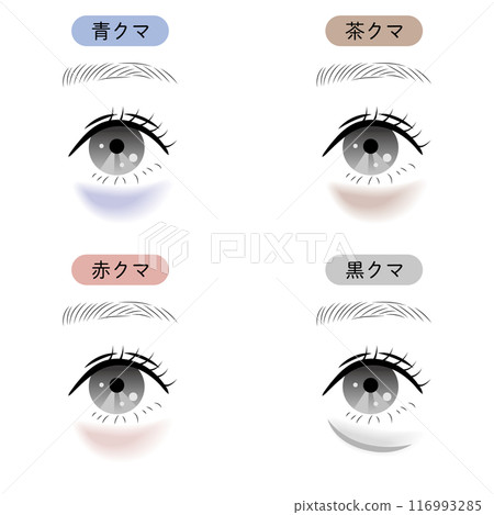 Types of dark circles under the eyes 116993285