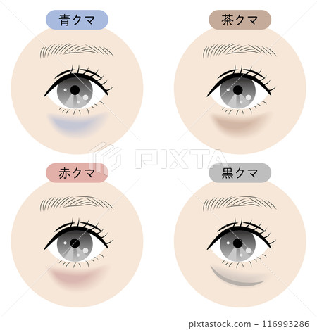 Types of dark circles under the eyes 116993286
