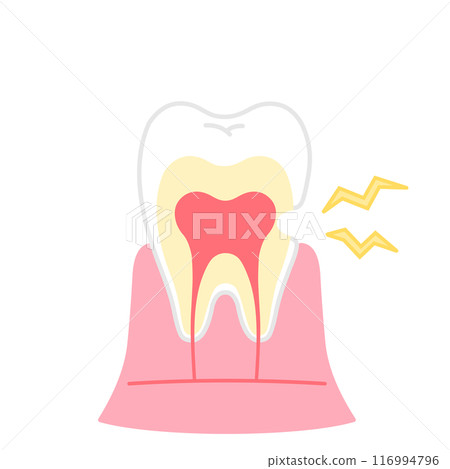 Illustration of worn dentin, tooth sensitivity, cross-section of tooth 116994796