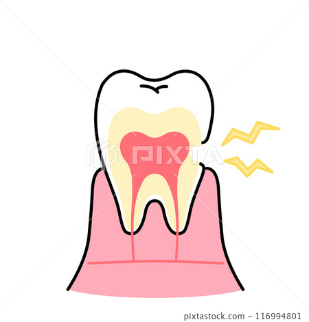 Illustration of worn dentin, tooth sensitivity, cross-section of tooth 116994801