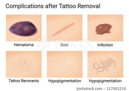 Skin Complications Post Tattoo Removal. Vector illustration design. 117001210