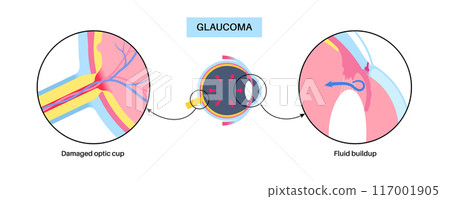 Glaucoma eye disease Glaucoma eye disease 117001905