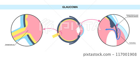 Glaucoma eye disease 117001908