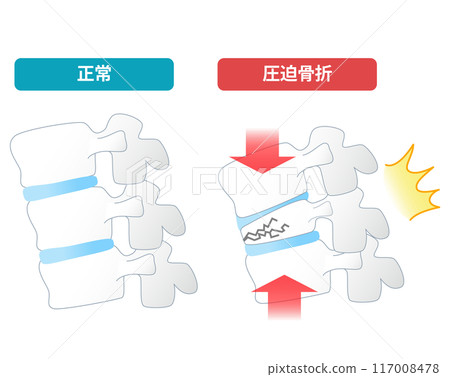 骨質疏鬆導致椎體壓迫性骨折的機制 117008478