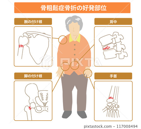 Illustration of areas prone to fractures due to osteoporosis and a full-body view of an elderly woman 117008494