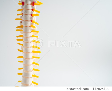 Lumbar spine displaced herniated disc fragment, spinal nerve and bone. Model for treatment medical in the orthopedic department. Lumbar spine displaced herniated disc fragment, spinal nerve and bone. Model for treatment medical in the orthopedic department. 117025190