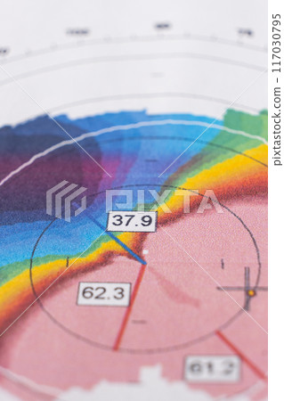 Results of the examination of the thickness and curvature of the cornea in a patient with keratoconus. 117030795