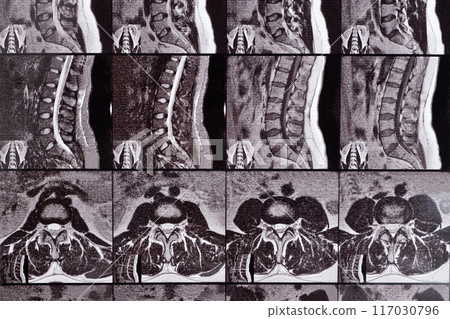 MRI of a patient with intervertebral disc protrusion and osteochondrosis of the thoracic spine MRI of a patient with intervertebral disc protrusion and osteochondrosis of the thoracic spine 117030796