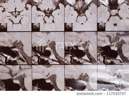 Magnetic resonance imaging of the head of a healthy person, image of the pituitary gland. Magnetic resonance imaging of the head of a healthy person, image of the pituitary gland. 117030797