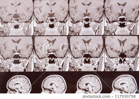 Magnetic resonance imaging of the head of a healthy person, image of the pituitary gland. Magnetic resonance imaging of the head of a healthy person, image of the pituitary gland. 117030798