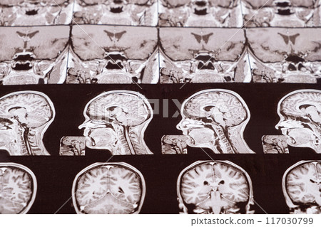 Magnetic resonance imaging of the head of a healthy person, image of the pituitary gland. Magnetic resonance imaging of the head of a healthy person, image of the pituitary gland. 117030799