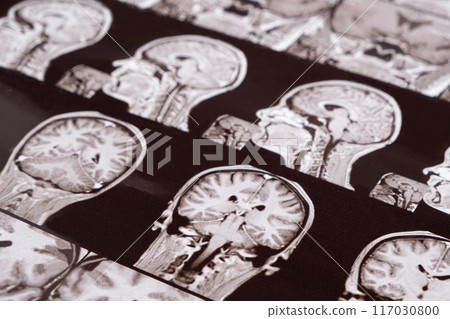 Magnetic resonance imaging of the head of a healthy person, image of the pituitary gland. 117030800
