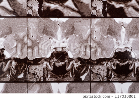 Magnetic resonance imaging of the head of a healthy person, image of the pituitary gland. 117030801