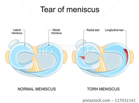 Meniscal tear. Torn meniscus. Knee injury. Meniscal tear. Torn meniscus. Knee injury. 117032141
