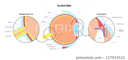 Glaucoma eye disease 117033522