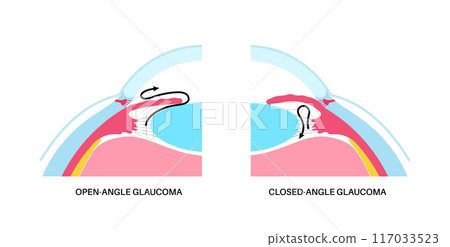 Glaucoma eye disease 117033523