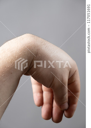 Ganglion cyst or hygroma of the wrist on the hand of a male patient Ganglion cyst or hygroma of the wrist on the hand of a male patient 117051691