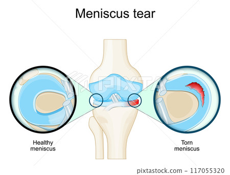 Meniscal tear. Knee anatomy. Close-up of Torn meniscus Meniscal tear. Knee anatomy. Close-up of Torn meniscus 117055320