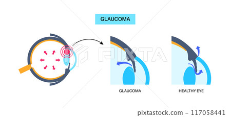 Glaucoma eye disease 117058441